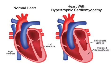 life expectancy cardiomyopathy in adults